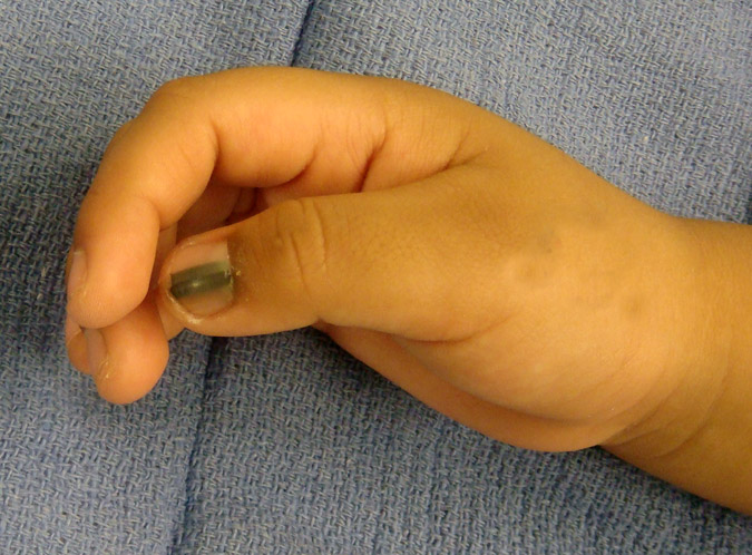 Blue nevus of the nail - wide 1